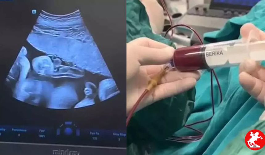 8 Aylık Bebeğe Anne Karnında Kan Nakli! Doktorlar Hayrete Düşüren Müdahaleyi Başarıyla Gerçekleştirdi