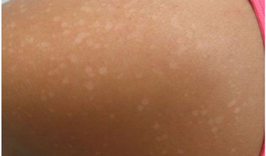 Beyaz Güneş Lekesi Neden Olur?