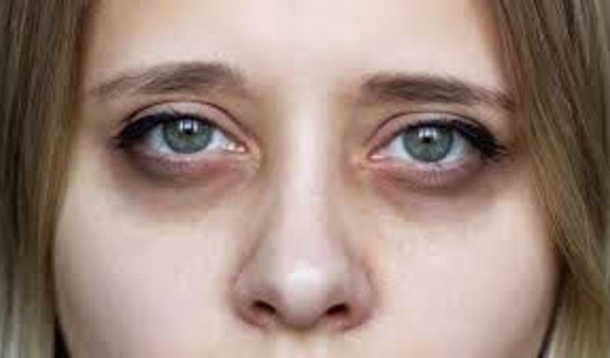 Göz Altı Morlukları Neden Oluşur? Kalıcı Çözüm Yöntemleri Nelerdir