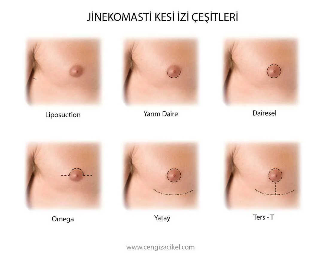 Jinekomasti Tedavisi